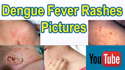 dengue fever rash features